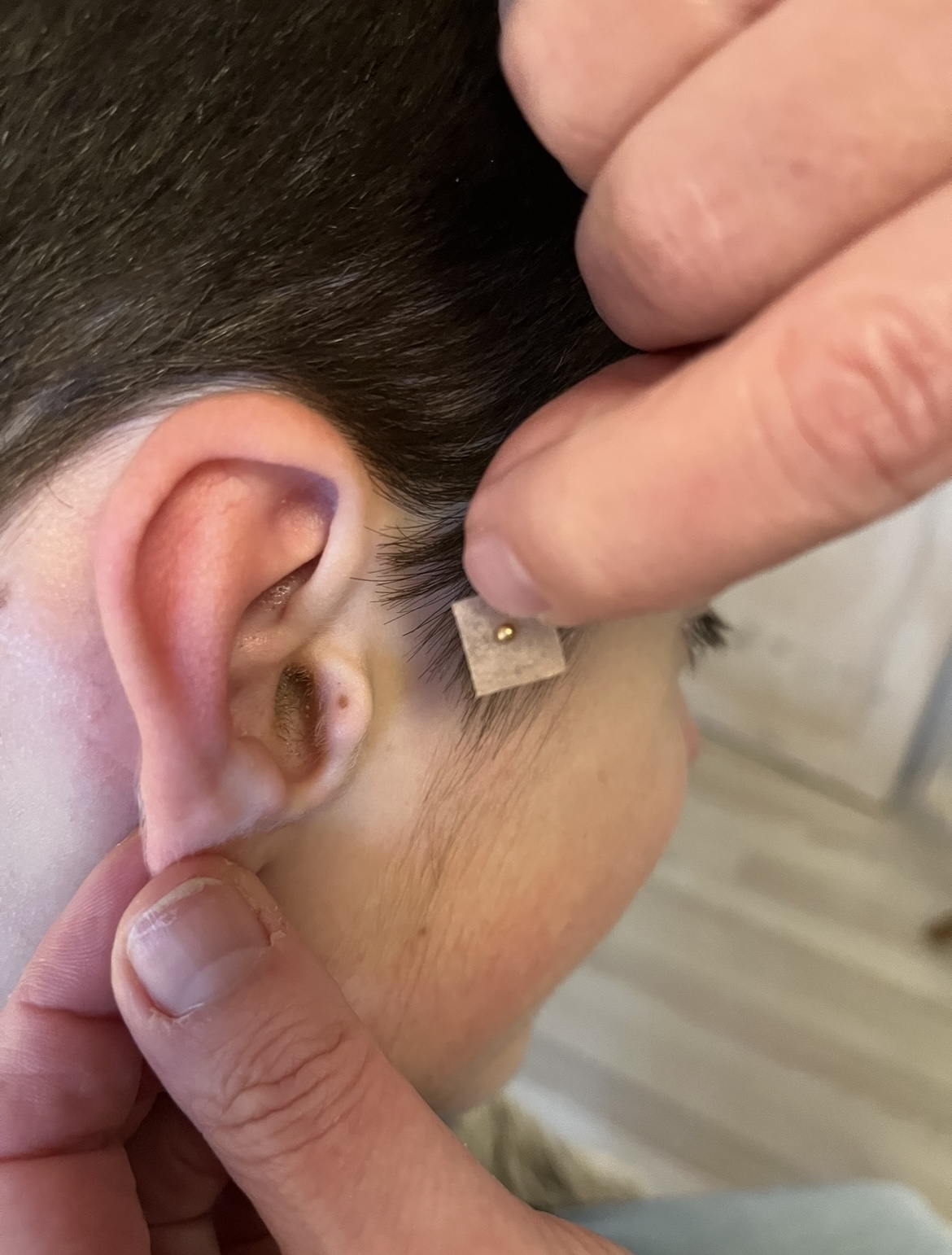 En behandler placerer et lille plaster med en nål på et barns øre under en øreakupunktur-session, der er tilpasset unge klienter.