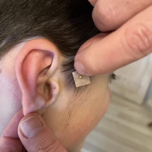 En behandler placerer et lille plaster med en nål på et barns øre under en øreakupunktur-session, der er tilpasset unge klienter.